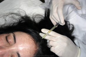 Recuperación del Cabello con Medicina Estética