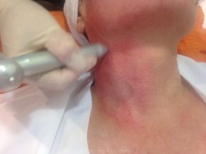 ¿Qué es el Needling?