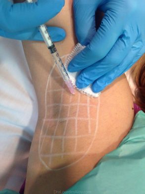 ¿Qué es la hiperhidrosis axilar?