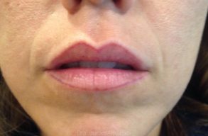 Aumento de Labios: Belleza, Armonía y Naturalidad