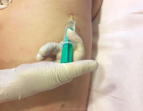 Mesoterapia Corporal