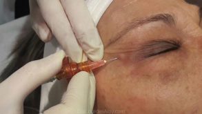Tratar las Ojeras Oscuras y el Contorno de Ojos