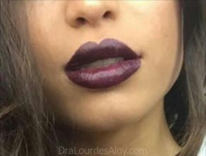 Relleno de labios temporal