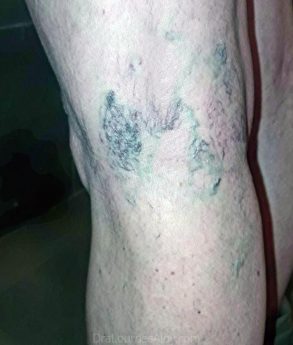 Lucir unas Piernas sin Varices