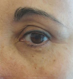 Ojeras pronunciadas