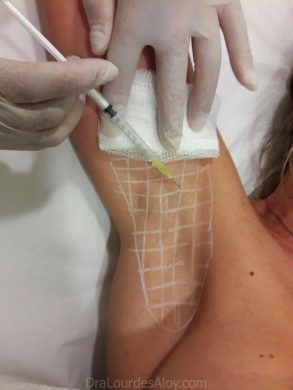 Toxina Botulínica en el ámbito médico