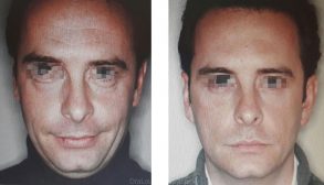 Toxina Botulínica para Hombres