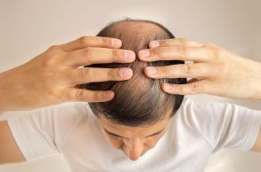 Alopecia Areata, un caso real