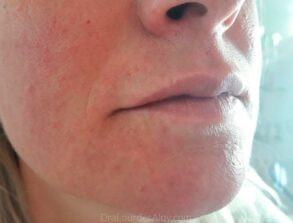 Relleno de Labios. Otro caso real