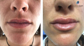 ¡En el relleno de labios, menos es más!