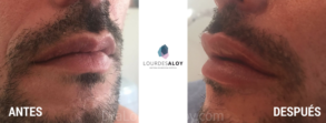 Un caso real de relleno de labios en hombres
