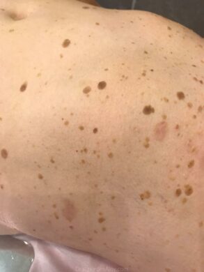 Queratosis: tratamiento con electrobisturí
