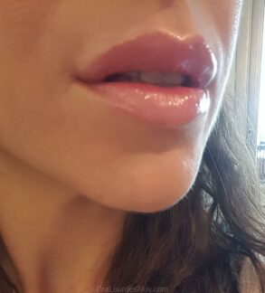 Relleno de Labios. Caso Real