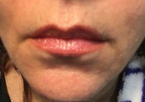 Micropigmentación de labios con Técnica Aquarela