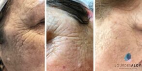 Rejuvenecimiento del contorno de los ojos