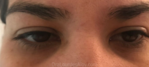 Ojeras Profundas y oscuras en pacientes jóvenes
