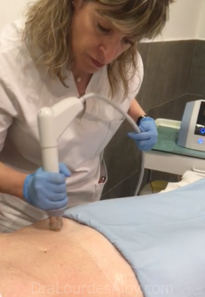 Ondas de Choque para el tratamiento de la grasa abdominal