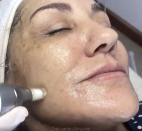 Meso Needling: Mesoterapia facial con la técnica Needling