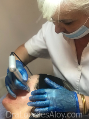Micropunción Nanopore: vitaminas faciales sin dolor ni hematomas.