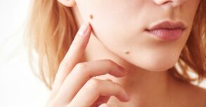 ¿Qué es un Nevus Papilomatoso?